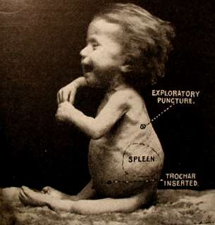   1907 FREAKS PHOTO MEDICAL BOOK Amazing Breast Pump Rare  