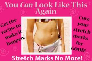   ANTI STRETCH MARK CREAM   during pregnancy Remover lines scars reducer